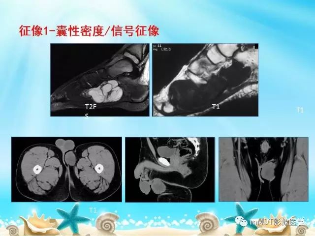 影像PPT - 【PPT】黏液样软组织肿瘤影像学-2