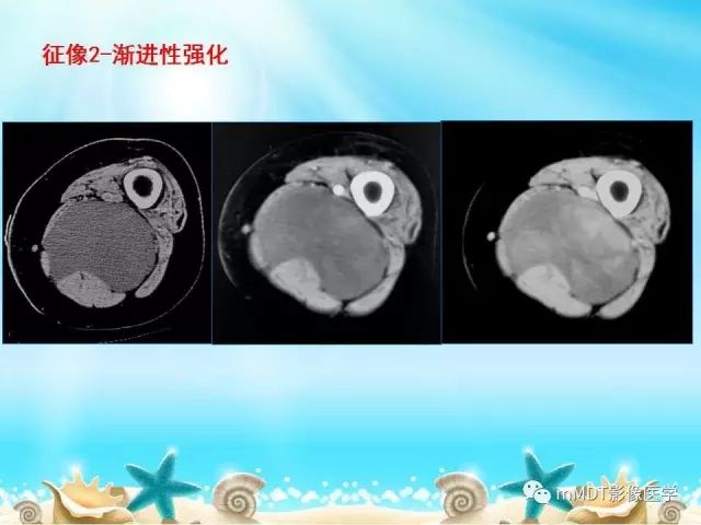 影像PPT - 【PPT】黏液样软组织肿瘤影像学-3