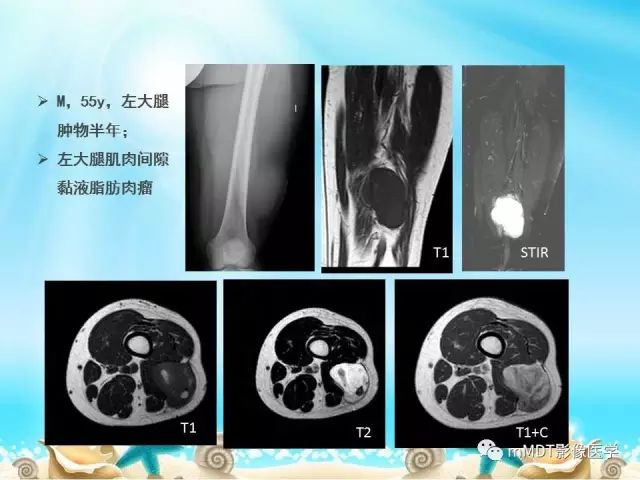 影像PPT - 【PPT】黏液样软组织肿瘤影像学-12