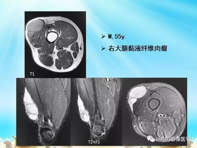 影像PPT - 【PPT】黏液样软组织肿瘤影像学-18