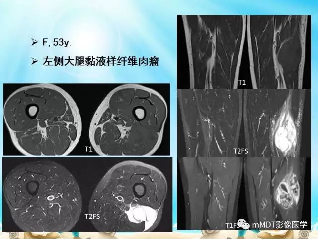 影像PPT - 【PPT】黏液样软组织肿瘤影像学-19