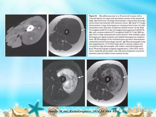 影像PPT - 【PPT】黏液样软组织肿瘤影像学-20