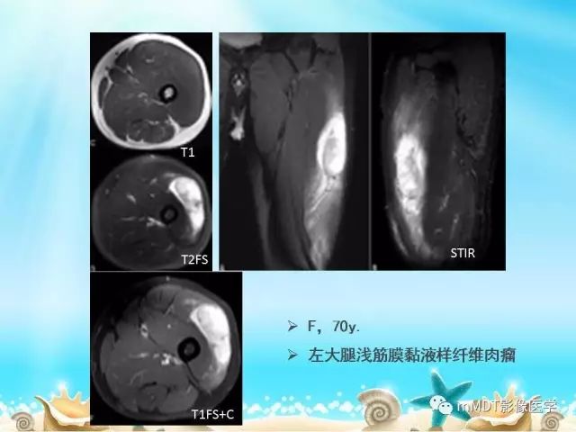 影像PPT - 【PPT】黏液样软组织肿瘤影像学-17