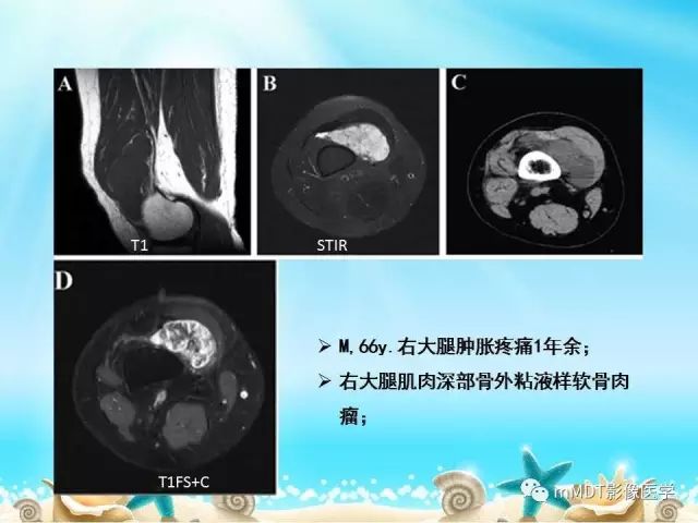 影像PPT - 【PPT】黏液样软组织肿瘤影像学-24