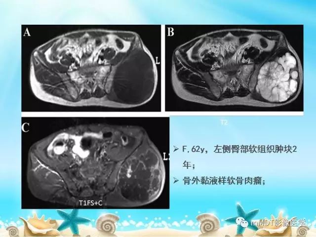 影像PPT - 【PPT】黏液样软组织肿瘤影像学-23