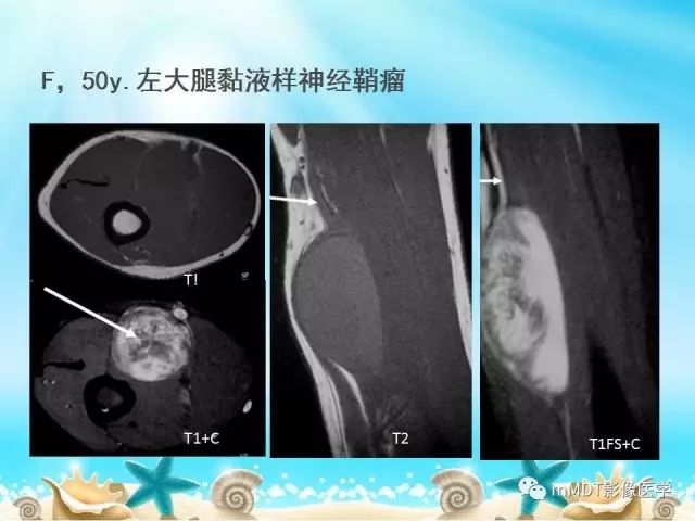 影像PPT - 【PPT】黏液样软组织肿瘤影像学-26