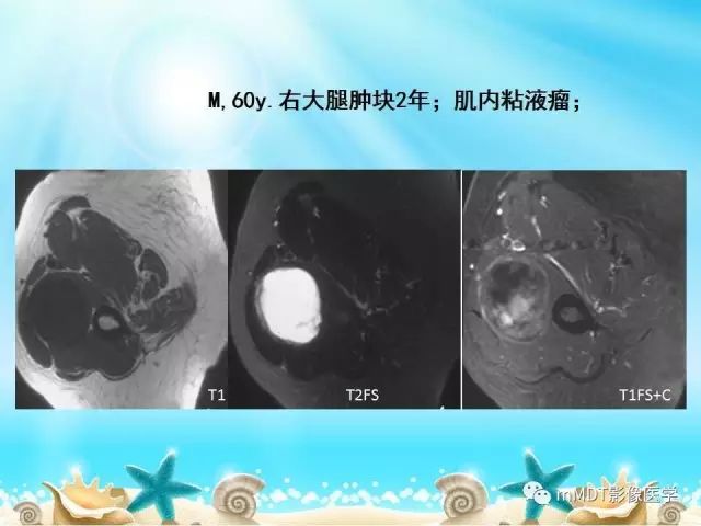 影像PPT - 【PPT】黏液样软组织肿瘤影像学-30