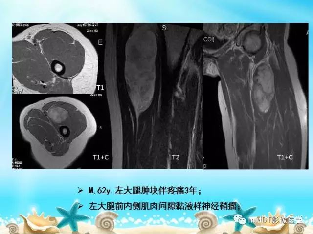 影像PPT - 【PPT】黏液样软组织肿瘤影像学-27