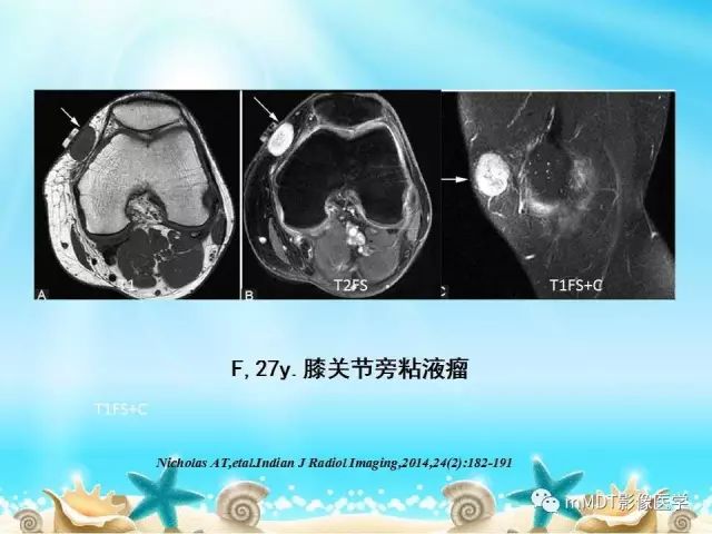 影像PPT - 【PPT】黏液样软组织肿瘤影像学-34