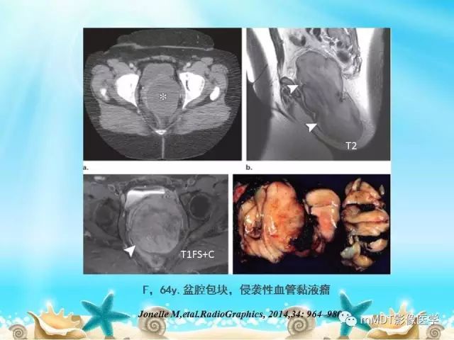 影像PPT - 【PPT】黏液样软组织肿瘤影像学-38