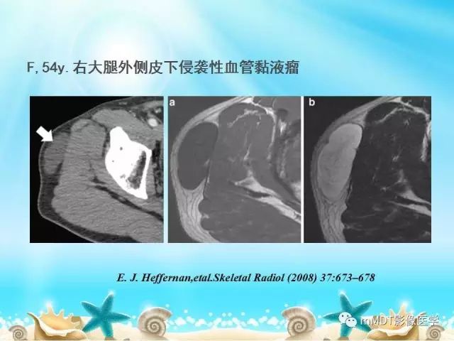 影像PPT - 【PPT】黏液样软组织肿瘤影像学-39