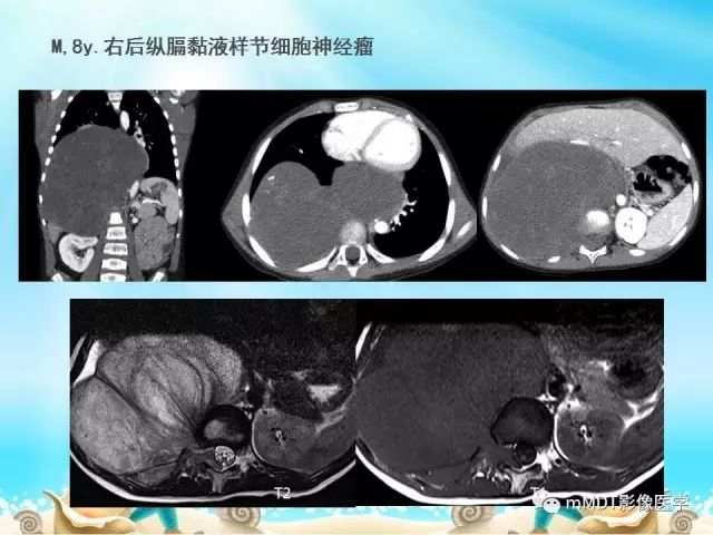 影像PPT - 【PPT】黏液样软组织肿瘤影像学-42