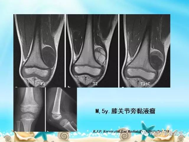 影像PPT - 【PPT】黏液样软组织肿瘤影像学-35