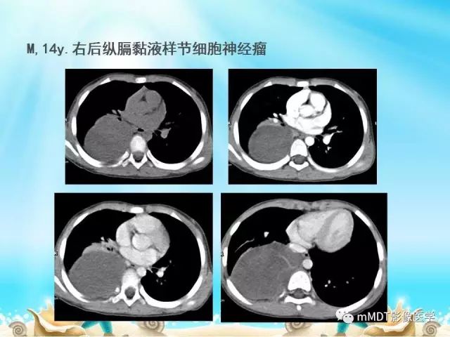影像PPT - 【PPT】黏液样软组织肿瘤影像学-43