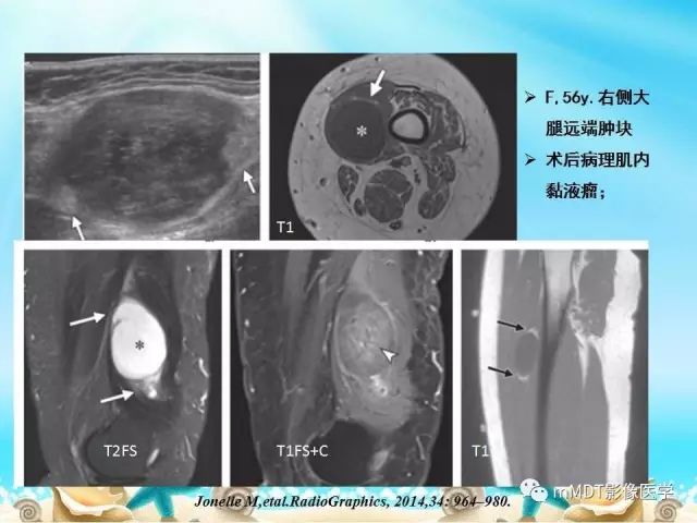 影像PPT - 【PPT】黏液样软组织肿瘤影像学-3