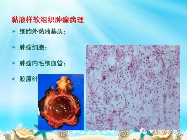 影像PPT - 【PPT】黏液样软组织肿瘤影像学-1