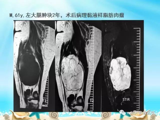 影像PPT - 【PPT】黏液样软组织肿瘤影像学-2