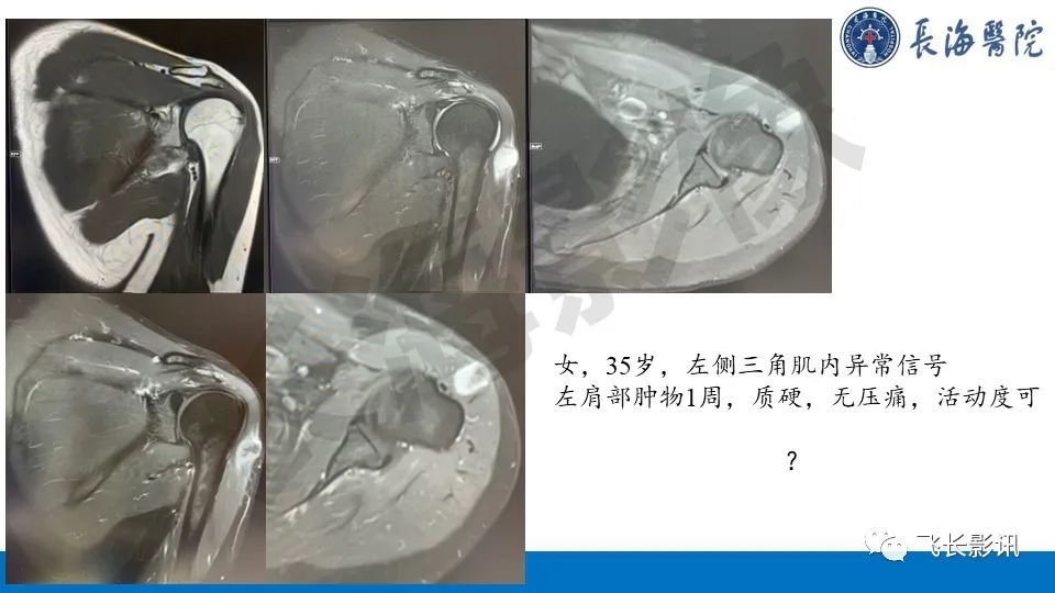 影像PPT - 【PPT】结节性筋膜炎-1