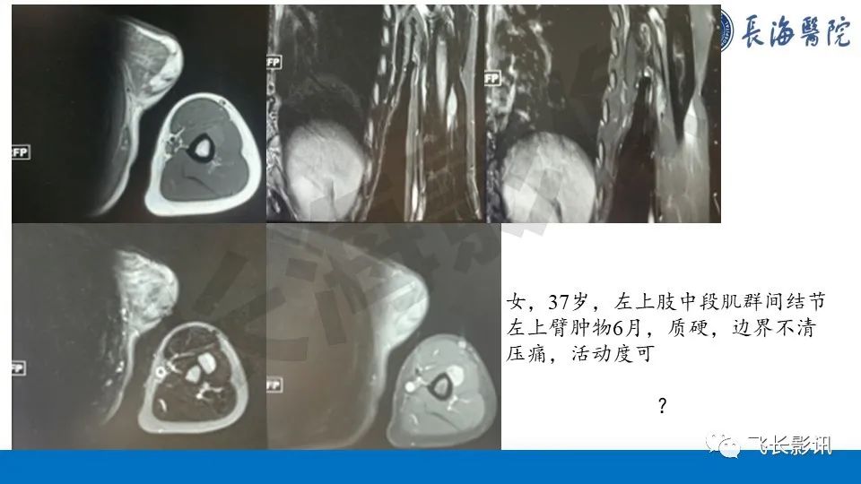 影像PPT - 【PPT】结节性筋膜炎-2