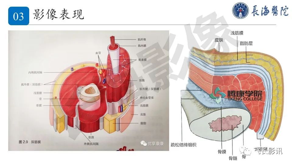 影像PPT - 【PPT】结节性筋膜炎-13
