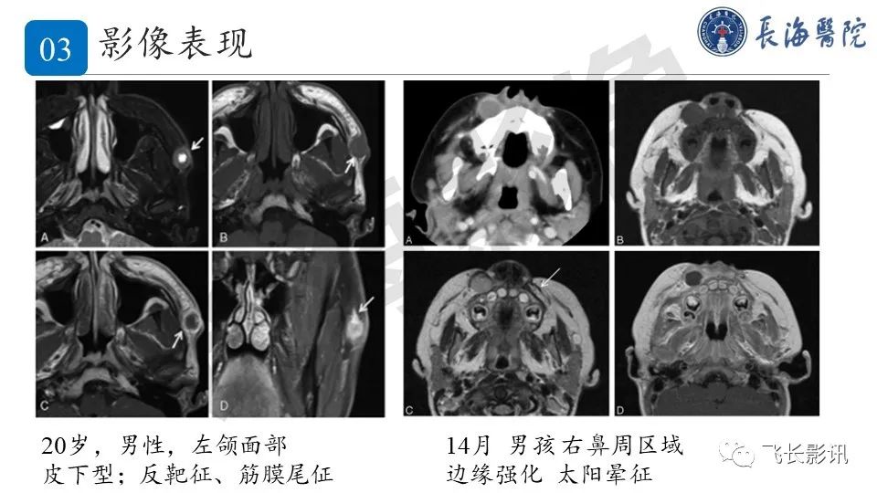 影像PPT - 【PPT】结节性筋膜炎-17