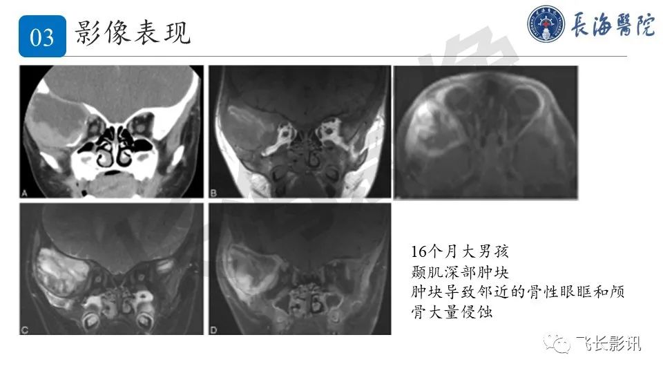 影像PPT - 【PPT】结节性筋膜炎-19