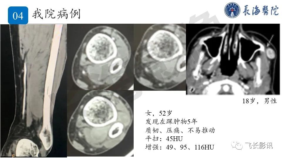 影像PPT - 【PPT】结节性筋膜炎-22