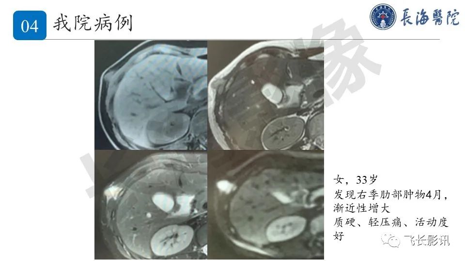 影像PPT - 【PPT】结节性筋膜炎-23