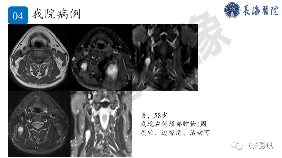 影像PPT - 【PPT】结节性筋膜炎-21