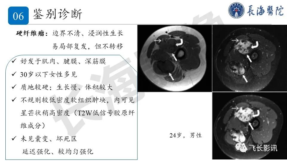 影像PPT - 【PPT】结节性筋膜炎-28