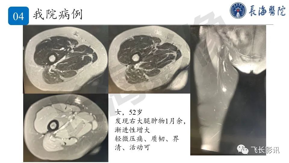 影像PPT - 【PPT】结节性筋膜炎-24