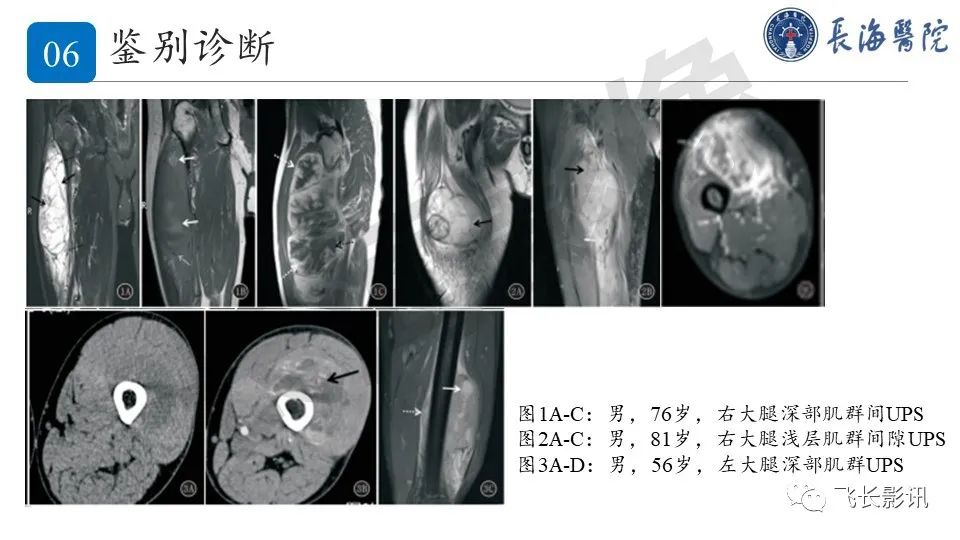影像PPT - 【PPT】结节性筋膜炎-31