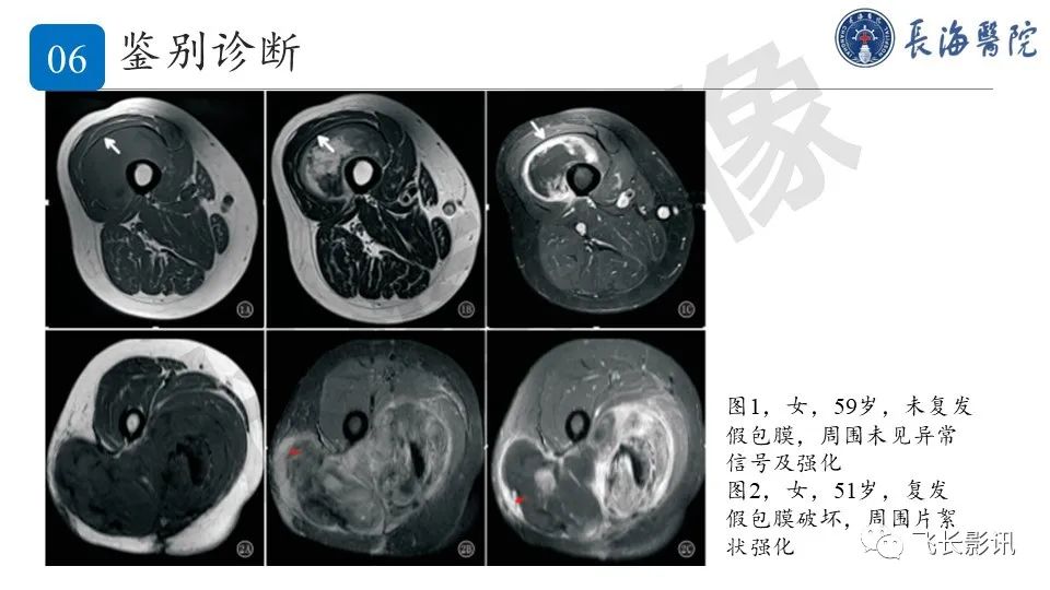 影像PPT - 【PPT】结节性筋膜炎-32