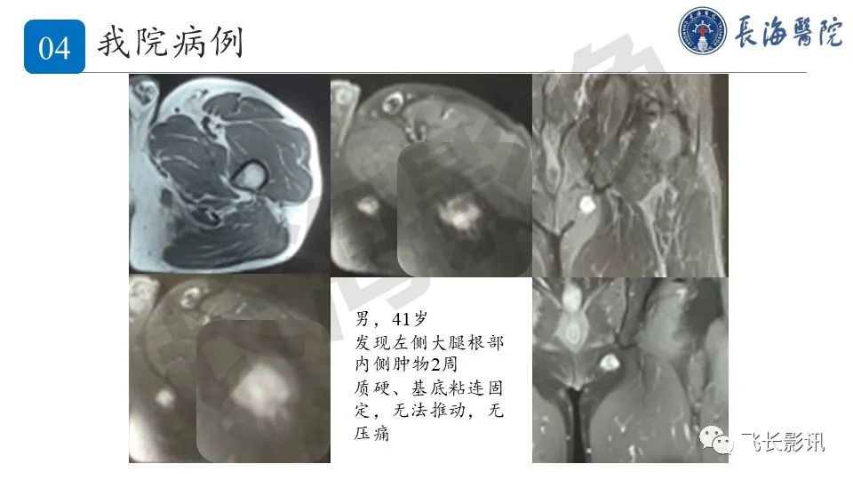 影像PPT - 【PPT】结节性筋膜炎-3