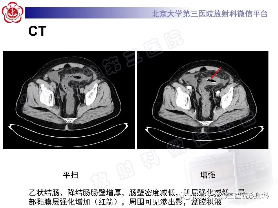 影像PPT - 【PPT】缺血性肠炎-3