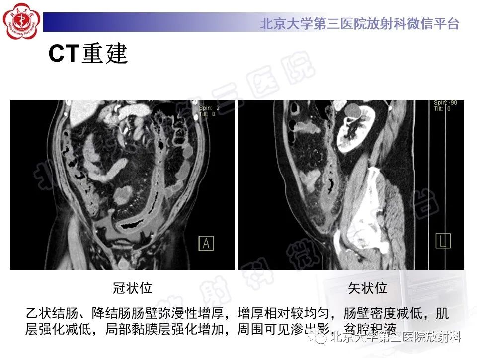 影像PPT - 【PPT】缺血性肠炎-4