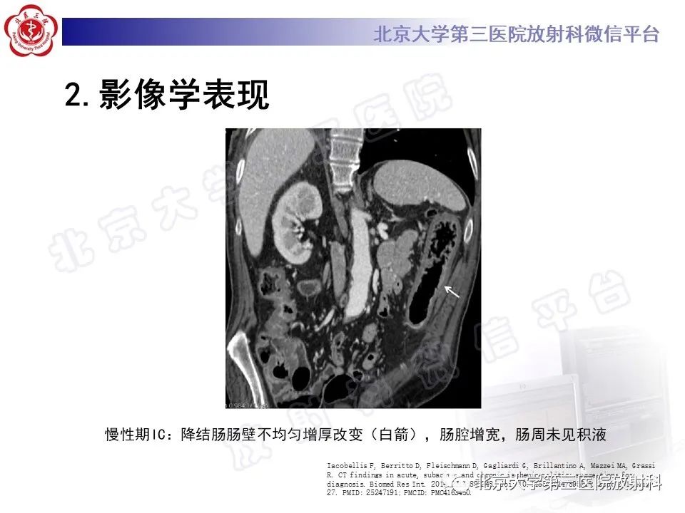 影像PPT - 【PPT】缺血性肠炎-20