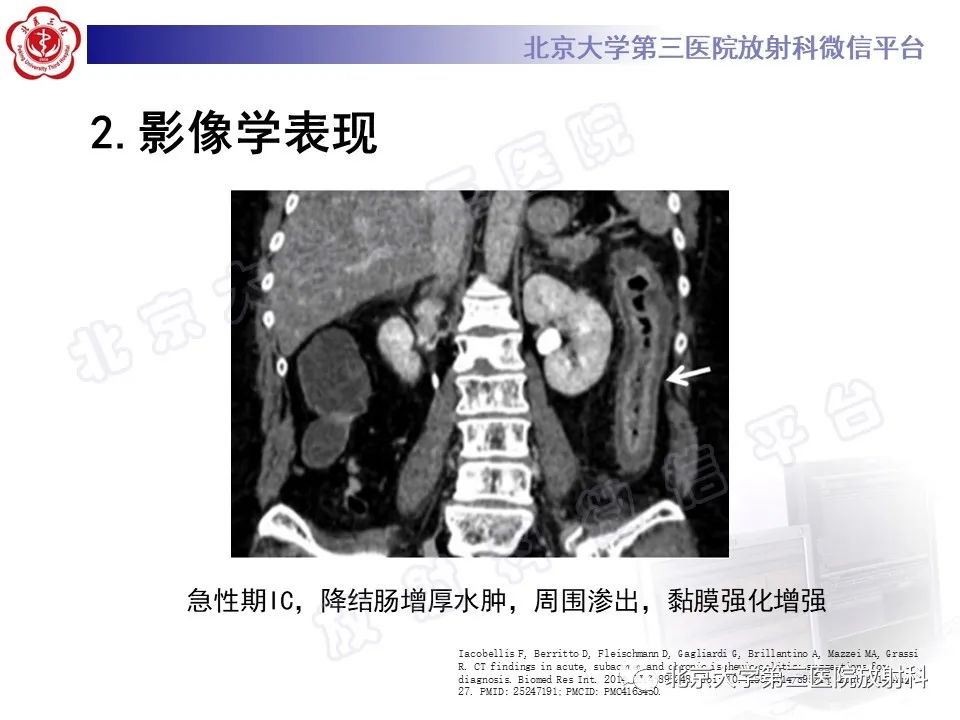 影像PPT - 【PPT】缺血性肠炎-16