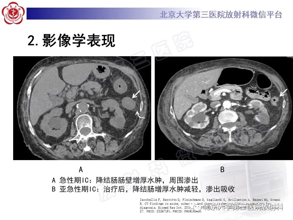 影像PPT - 【PPT】缺血性肠炎-18