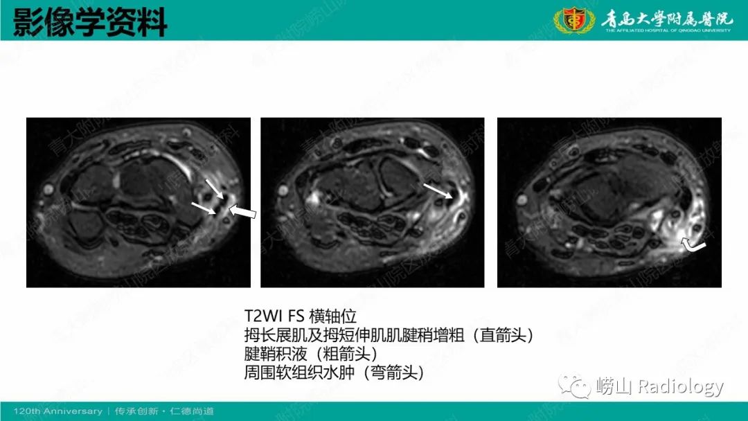 影像PPT - 【病例】桡骨茎突狭窄性腱鞘炎1例MR-9