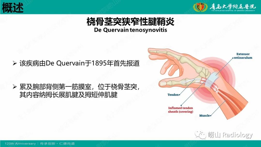 影像PPT - 【病例】桡骨茎突狭窄性腱鞘炎1例MR-10