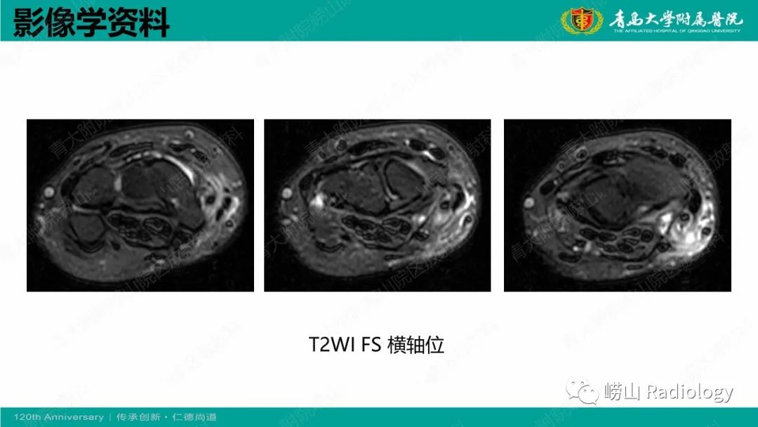 影像PPT - 【病例】桡骨茎突狭窄性腱鞘炎1例MR-5