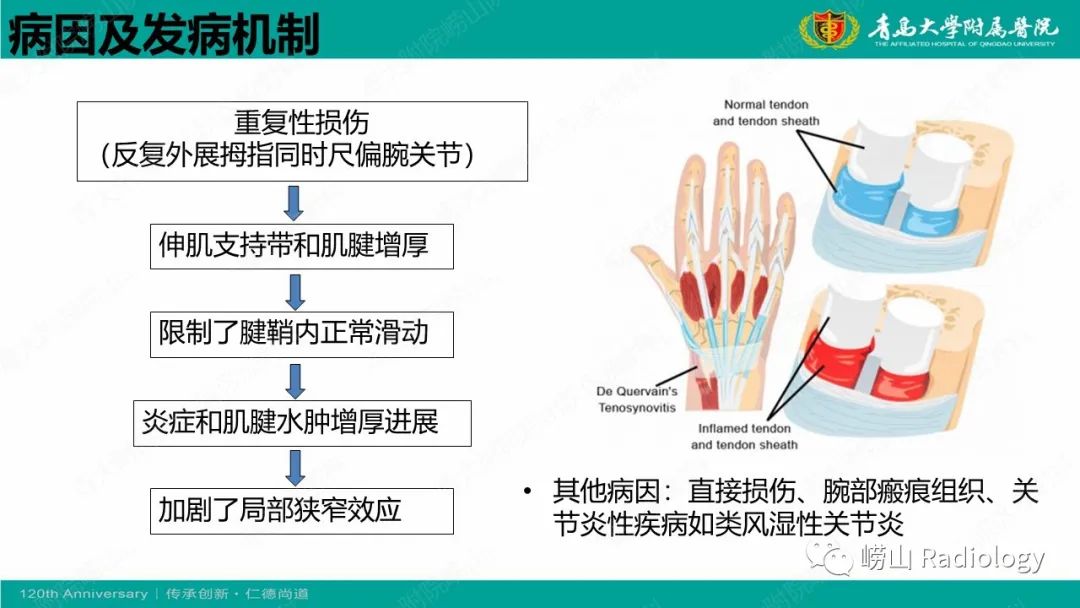 影像PPT - 【病例】桡骨茎突狭窄性腱鞘炎1例MR-11
