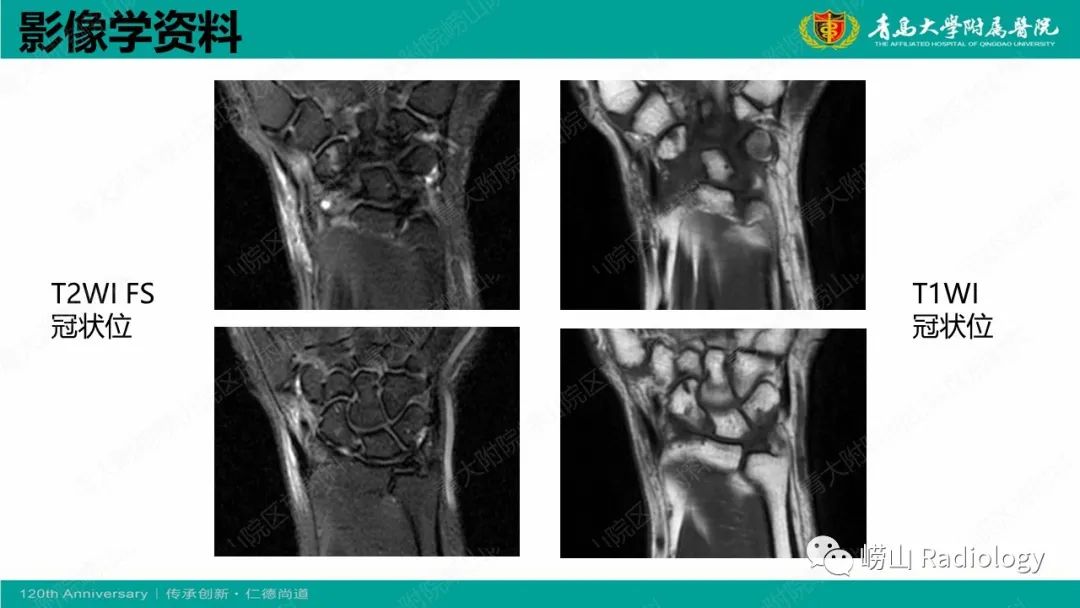 影像PPT - 【病例】桡骨茎突狭窄性腱鞘炎1例MR-4
