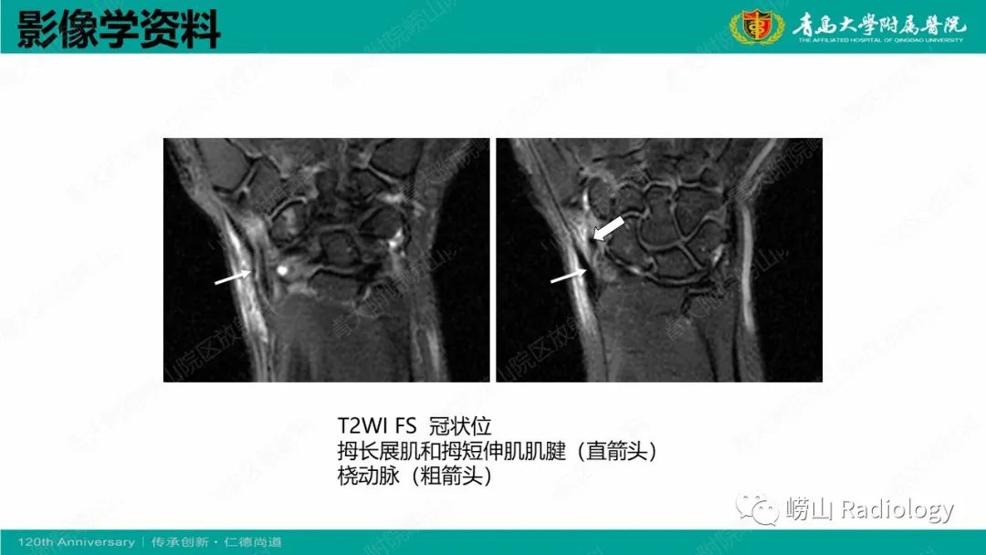 影像PPT - 【病例】桡骨茎突狭窄性腱鞘炎1例MR-8