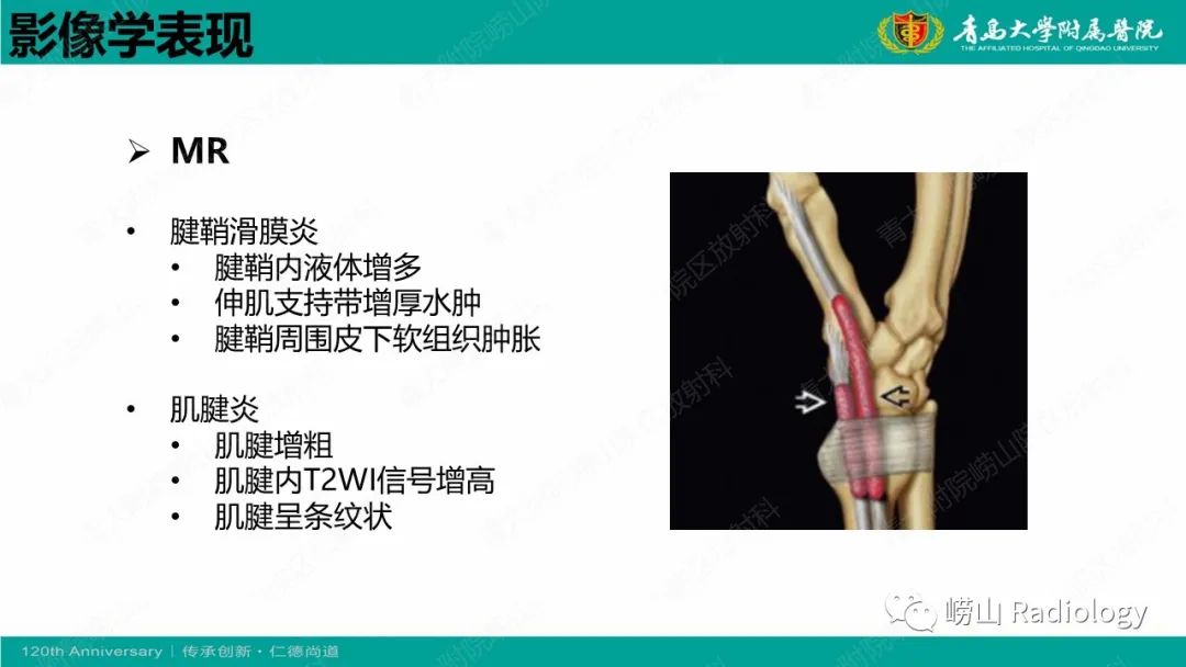 影像PPT - 【病例】桡骨茎突狭窄性腱鞘炎1例MR-16