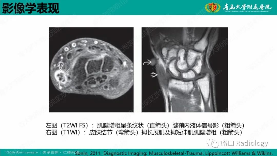 影像PPT - 【病例】桡骨茎突狭窄性腱鞘炎1例MR-18