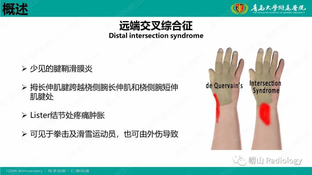 影像PPT - 【病例】桡骨茎突狭窄性腱鞘炎1例MR-21