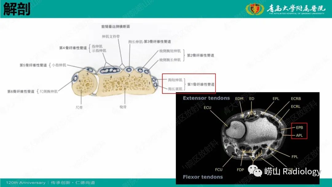 影像PPT - 【病例】桡骨茎突狭窄性腱鞘炎1例MR-14