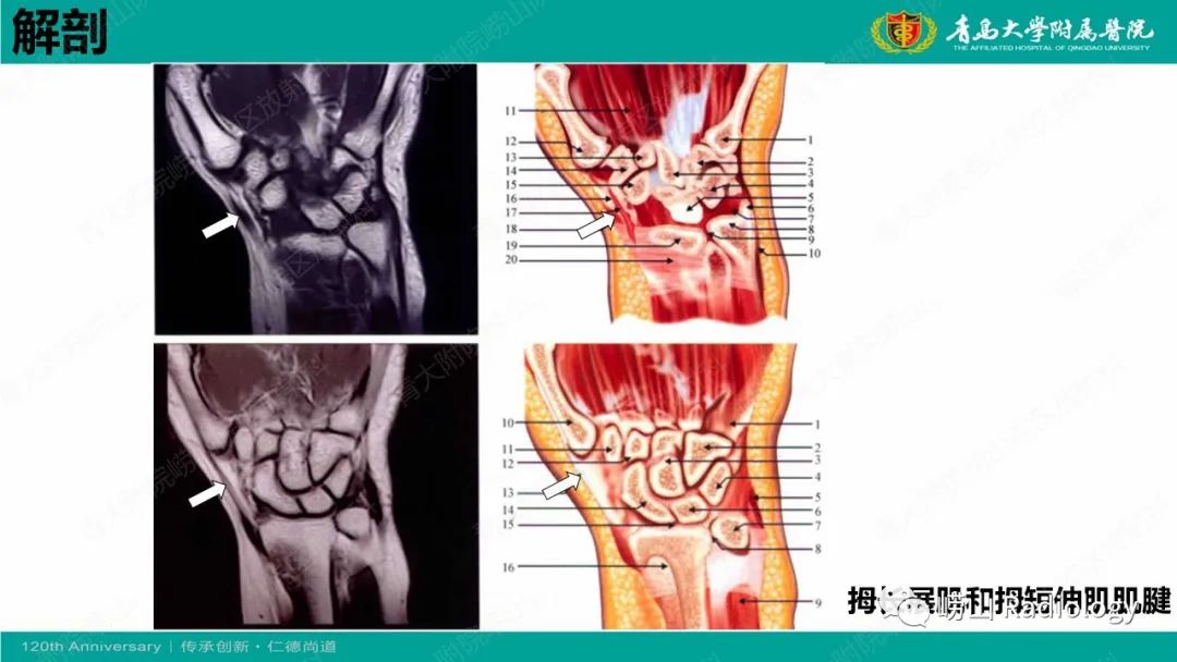 影像PPT - 【病例】桡骨茎突狭窄性腱鞘炎1例MR-15